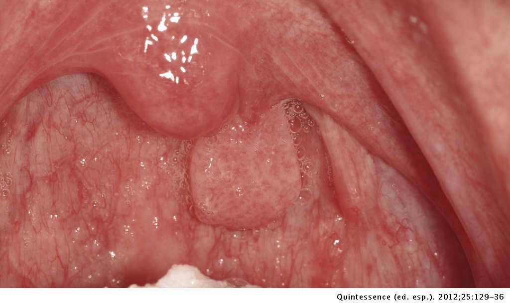 Is hpv throat cancer rare, Hpv throat cancer chemo