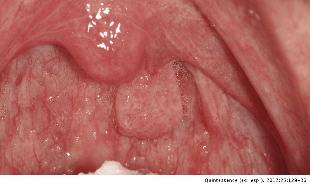 papiloma escamoso uvula