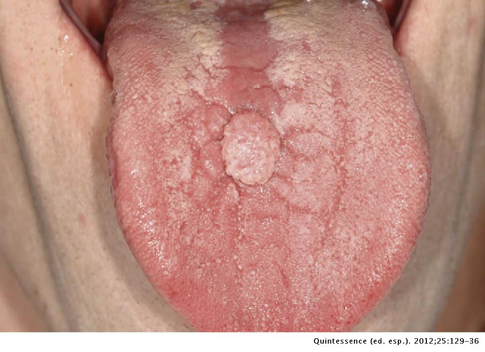 Papiloma benigno boca. ¿Cómo se toma biopsia en la boca? oxiuros tratamiento puc