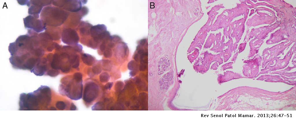 Papiloma intraductal cid. Hpv genital cid