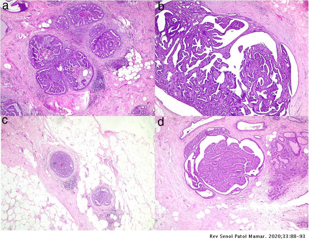 papiloma intraductal biopsia