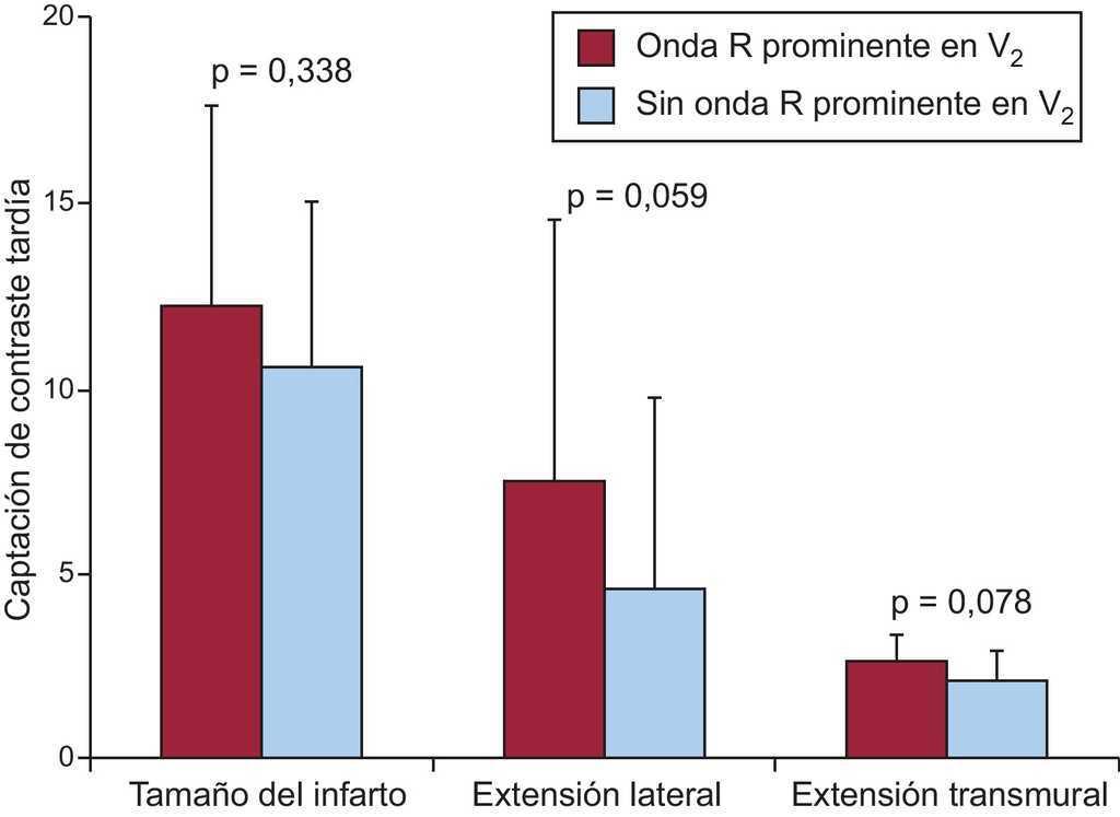 La Onda R Prominente En V 1 Pero No En V 2 Es Un Signo Especifico De Infarto Transmural Lateral Grande Revista Espanola De Cardiologia