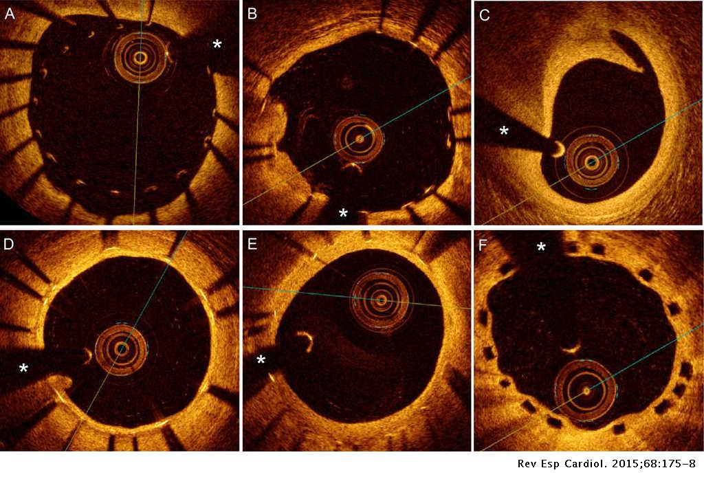Optimización Del Implante De Stents Guiado Por Tomografía De Coherencia Optimización Del Implante De Stents Guiado Por Tomografía De Coherencia