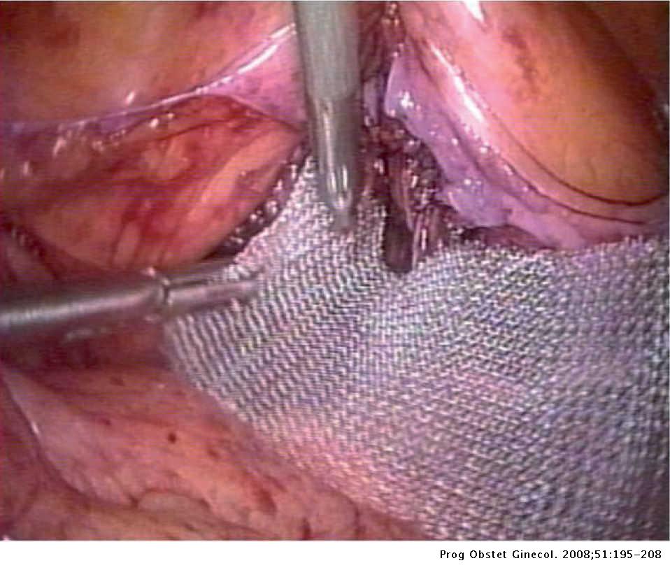 raíz Abigarrado No lo hagas Colposacropexia por laparoscopia en el tratamiento del prolapso genital |  Progresos de Obstetricia y Ginecología