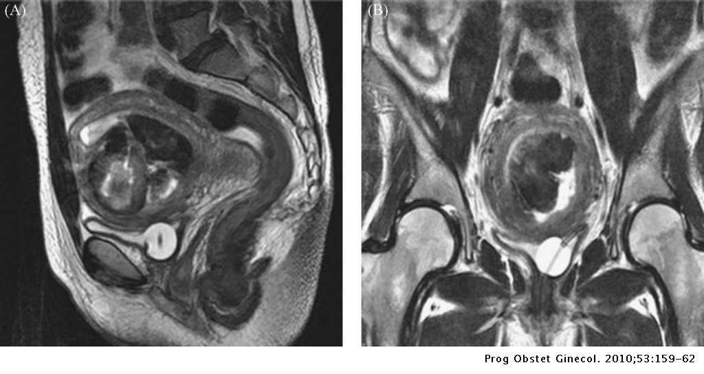 Resonancia Pelvica Con Contraste Preparacion Piomioma tras aborto de segundo trimestre de gestación | Progresos de