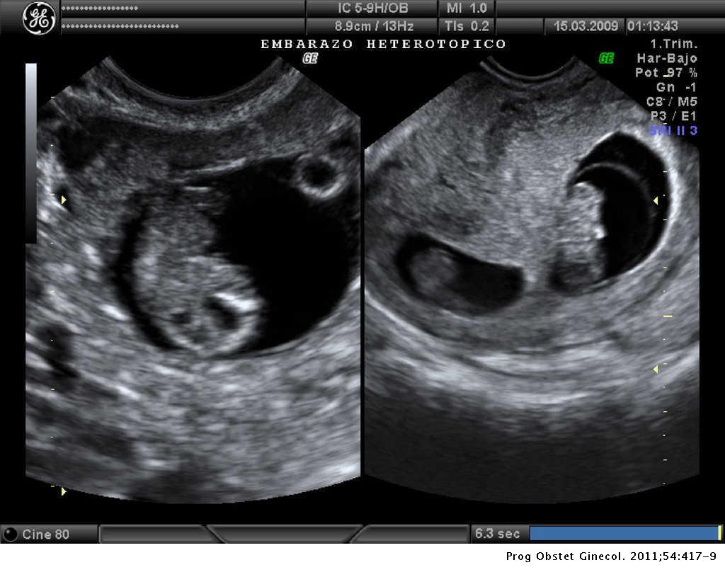 Embarazo Gemelar Despues De Cesarea Gestación heterotópica triple: gestación gemelar intrauterina