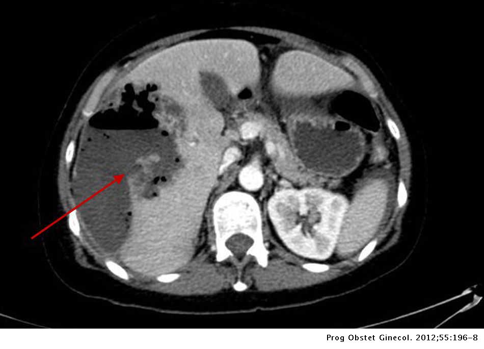 Absceso Hepatico Roto En Portadora De Dispositivo Intrauterino Progresos De Obstetricia Y Ginecologia Absceso Hepatico Roto En Portadora De Dispositivo Intrauterino Progresos De Obstetricia Y Ginecologia