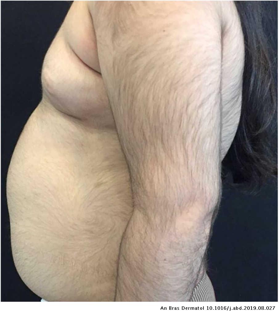 Cyclosporine-induced childhood generalized hypertrichosis | Anais Brasileiros de Dermatologia Cyclosporine-induced childhood generalized hypertrichosis | Anais Brasileiros de Dermatologia