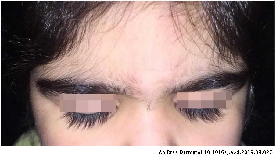 Cyclosporine-induced childhood generalized hypertrichosis | Anais Brasileiros de Dermatologia Cyclosporine-induced childhood generalized hypertrichosis | Anais Brasileiros de Dermatologia