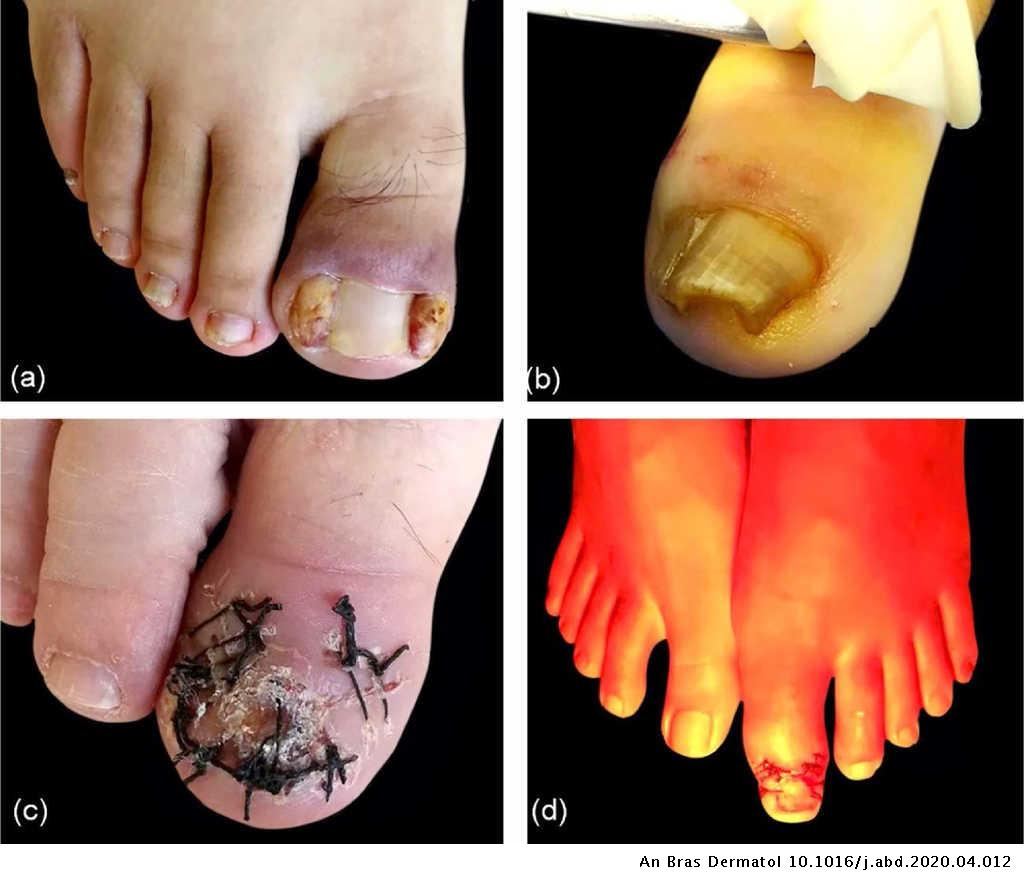 Six steps to standardize the surgical approach for ingrown toenail | Anais Brasileiros de Dermatologia (Portuguese) Six steps to standardize the surgical approach for ingrown toenail | Anais Brasileiros de Dermatologia (Portuguese)