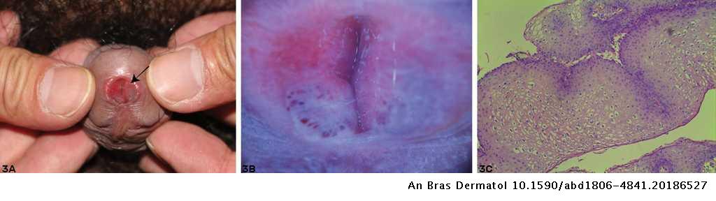 Hpv warts in urethra. Squamous papilloma urethra