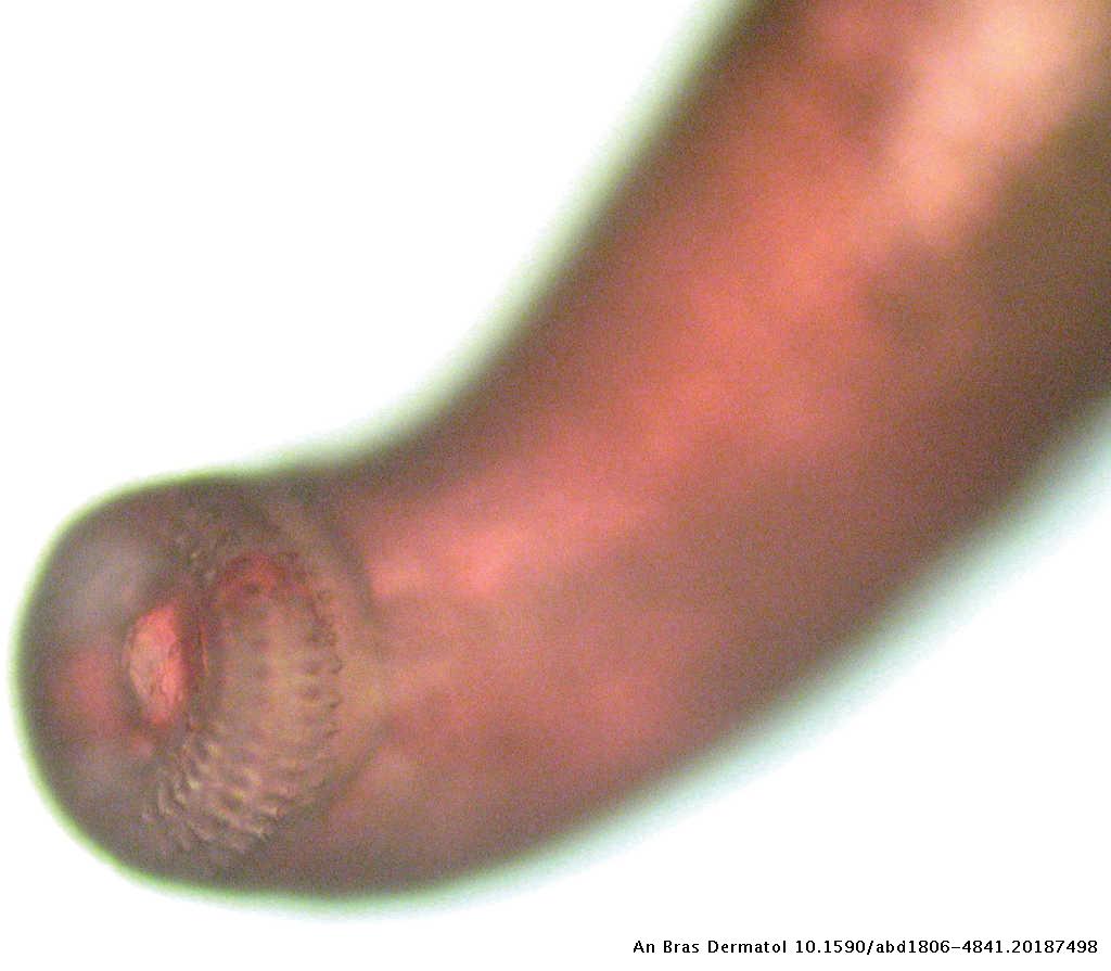 Gnathostomiasis An Emerging Infectious Disease Relevant To All Dermatologists Anais Brasileiros De Dermatologia Gnathostomiasis An Emerging Infectious Disease Relevant To All Dermatologists Anais Brasileiros De Dermatologia