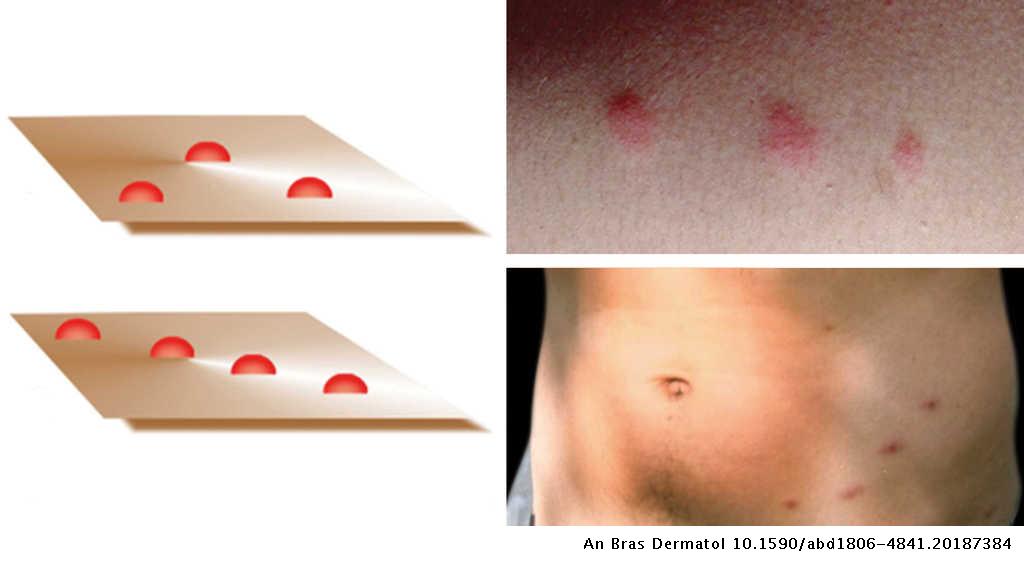 Breakfast, lunch, and dinner sign: a hallmark of flea and bedbug bites ...