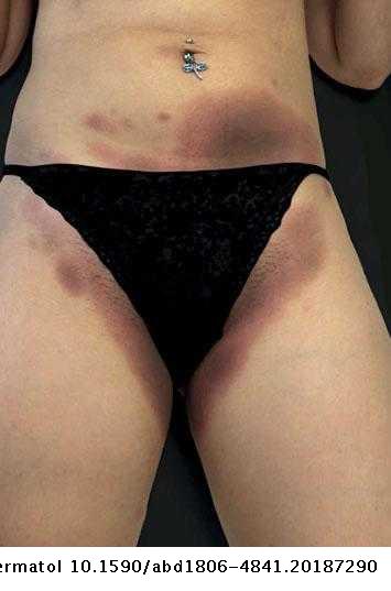 Autoimmune Progesterone Dermatitis Manifesting As Generalized Fixed Drug Eruption Anais Brasileiros De Dermatologia Portuguese Autoimmune Progesterone Dermatitis Manifesting As Generalized Fixed Drug Eruption Anais Brasileiros De Dermatologia Portuguese