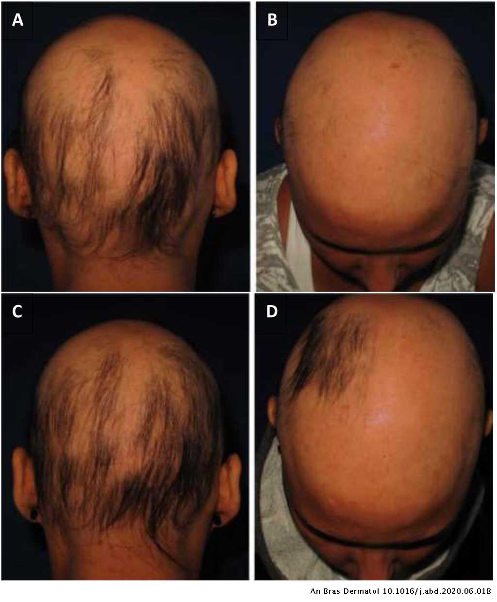 Randomized controlled study comparing the use of diphencyprone and  anthralin in the treatment of extensive chronic alopecia areata | Anais  Brasileiros de Dermatologia