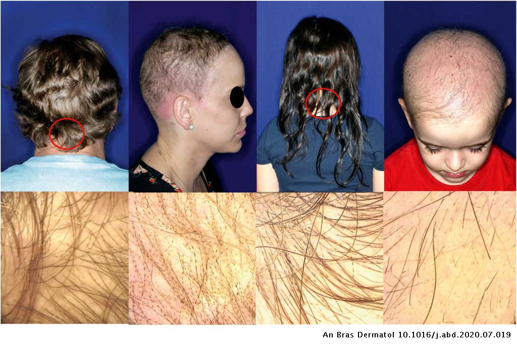 Moniletrix of the scalp from almost normal aspect to total alopecia: variable intrafamilial expressiveness | Anais Brasileiros de Dermatologia (Portuguese) Moniletrix of the scalp from almost normal aspect to total alopecia: variable intrafamilial expressiveness | Anais Brasileiros de Dermatologia (Portuguese)