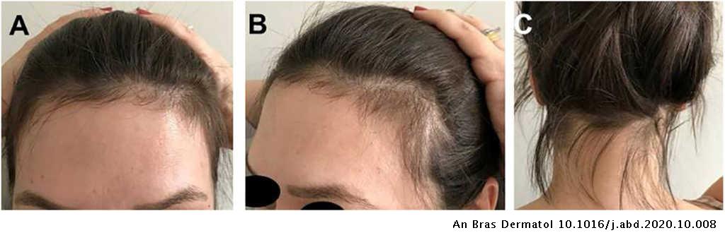 Acute telogen effluvium triad after resolution | Anais Brasileiros de Dermatologia Acute telogen effluvium triad after resolution | Anais Brasileiros de Dermatologia