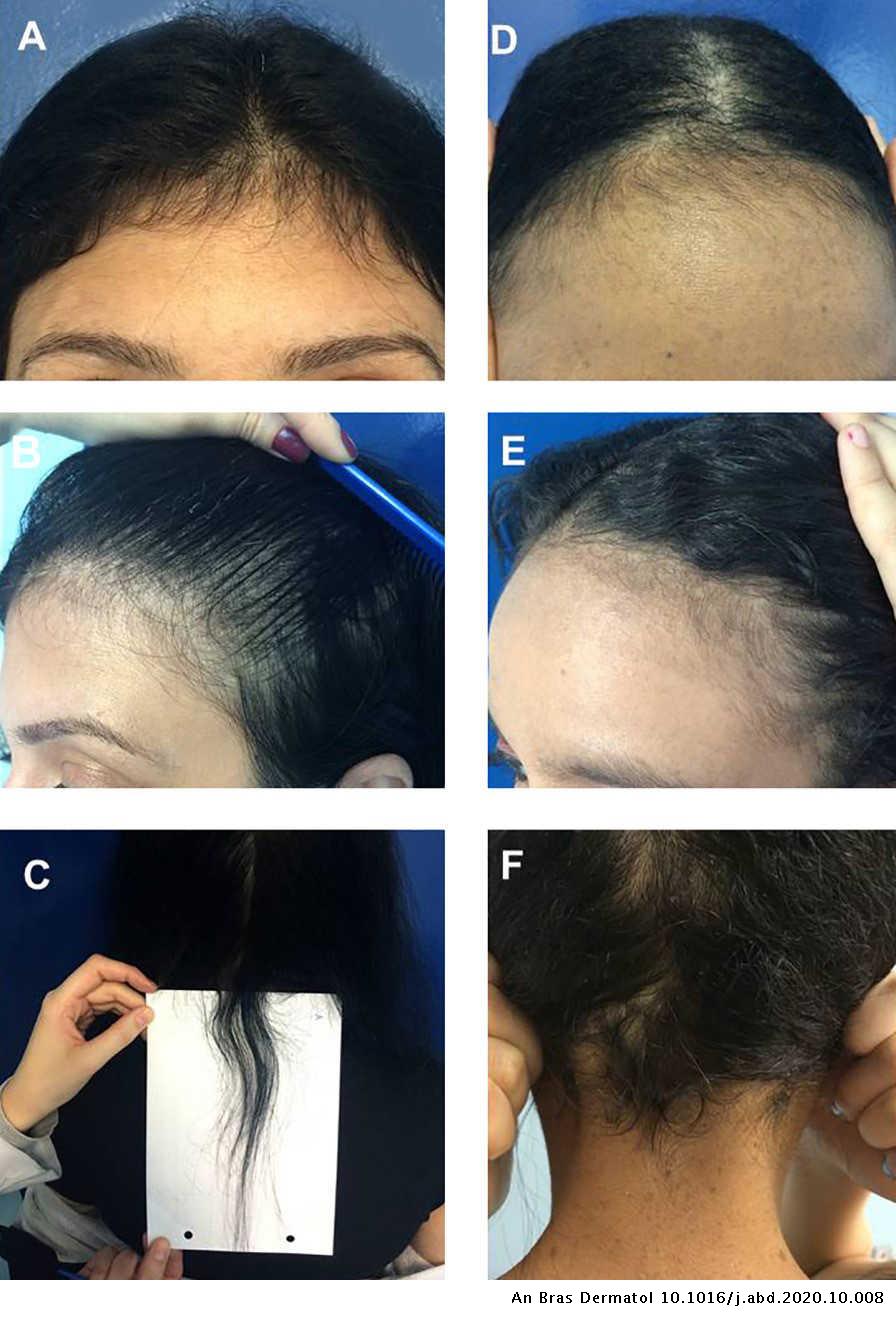 Acute telogen effluvium triad after resolution | Anais Brasileiros de Dermatologia Acute telogen effluvium triad after resolution | Anais Brasileiros de Dermatologia