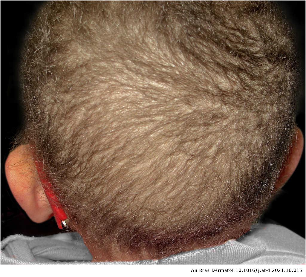 Case for diagnosis. Hair analysis in a child with delayed psychomotor development and fragile and brittle hair: Trichothiodystrophy | Anais Brasileiros de Dermatologia Case for diagnosis. Hair analysis in a child with delayed psychomotor development and fragile and brittle hair: Trichothiodystrophy | Anais Brasileiros de Dermatologia
