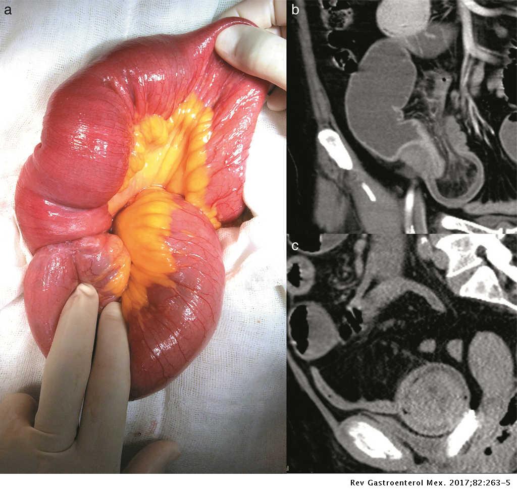 Oclusión intestinal en el adulto por intususcepción ileal secundaria a pólipo fibroide inflamatorio: reporte un caso | Revista de Gastroenterología de México