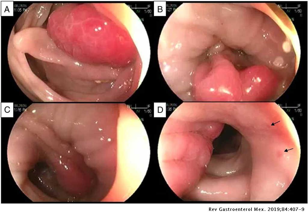 Pólipo de prolapso mucoso: una forma de pólipo del colon que no debe ser  olvidada | Revista de Gastroenterología de México