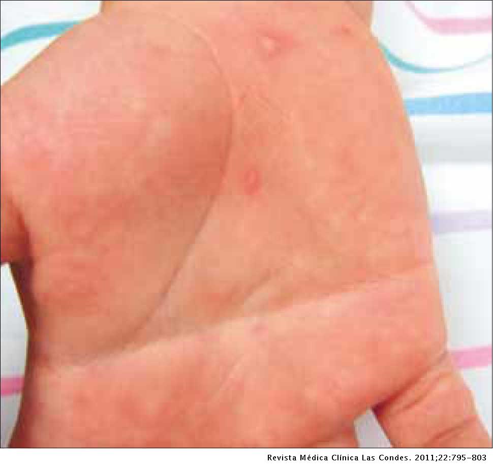 Infecciones virales en piel y mucosas | Revista Médica Clínica Las Condes