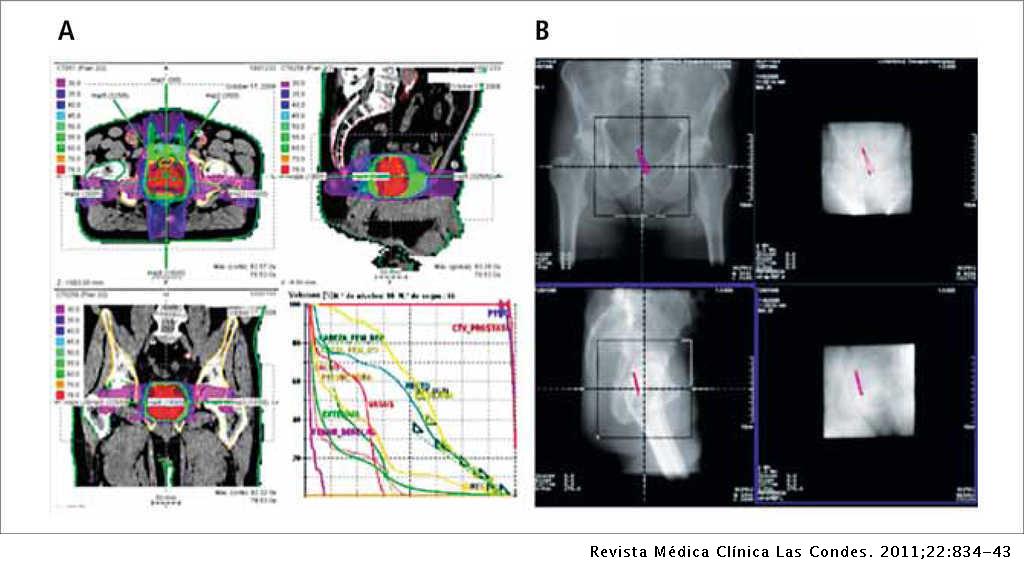 radioterapia en cáncer de próstata pdf)