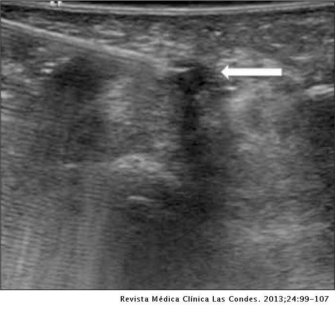 A térd artrózisának radiológiai tünetei