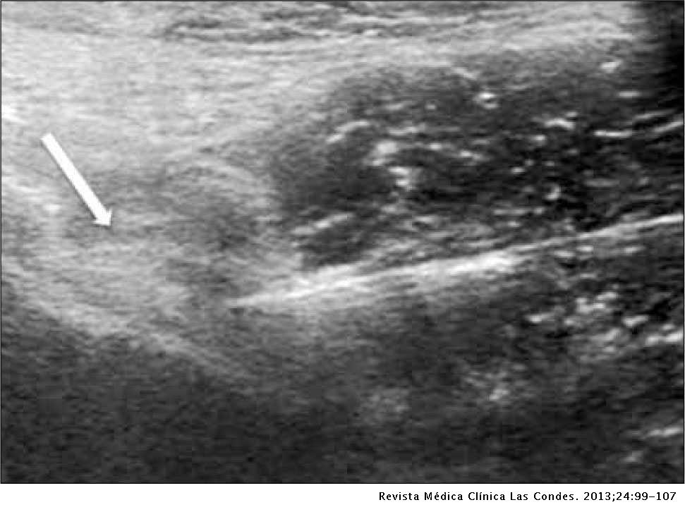 A csípőízületek artrózisának radiológiai jelei