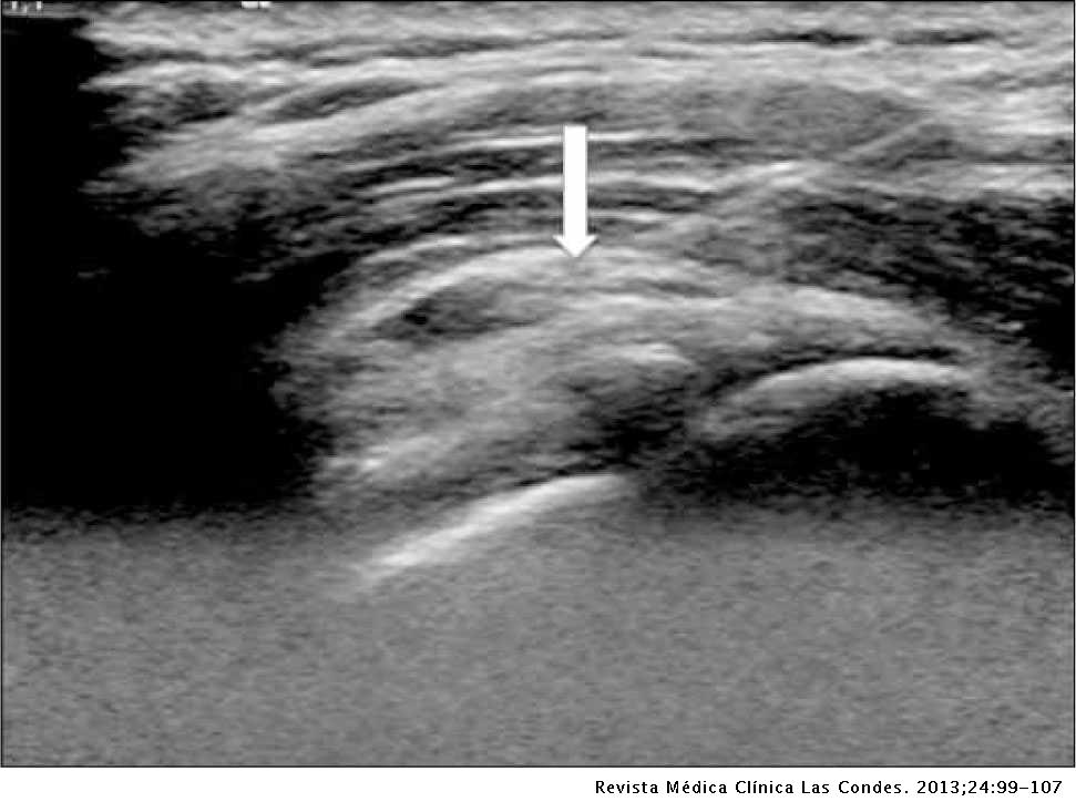 Arthrózis (porckopás) tünetei és kezelése - HáziPatika A térd radiológiai stádiumainak artrózisa
