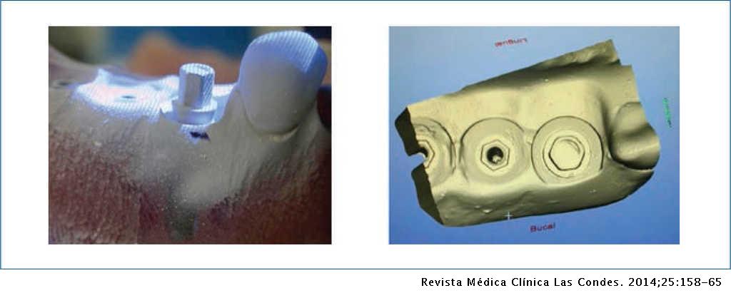 Uso de coronas sistema cad-cam en implantes osteointegrados | Revista ...
