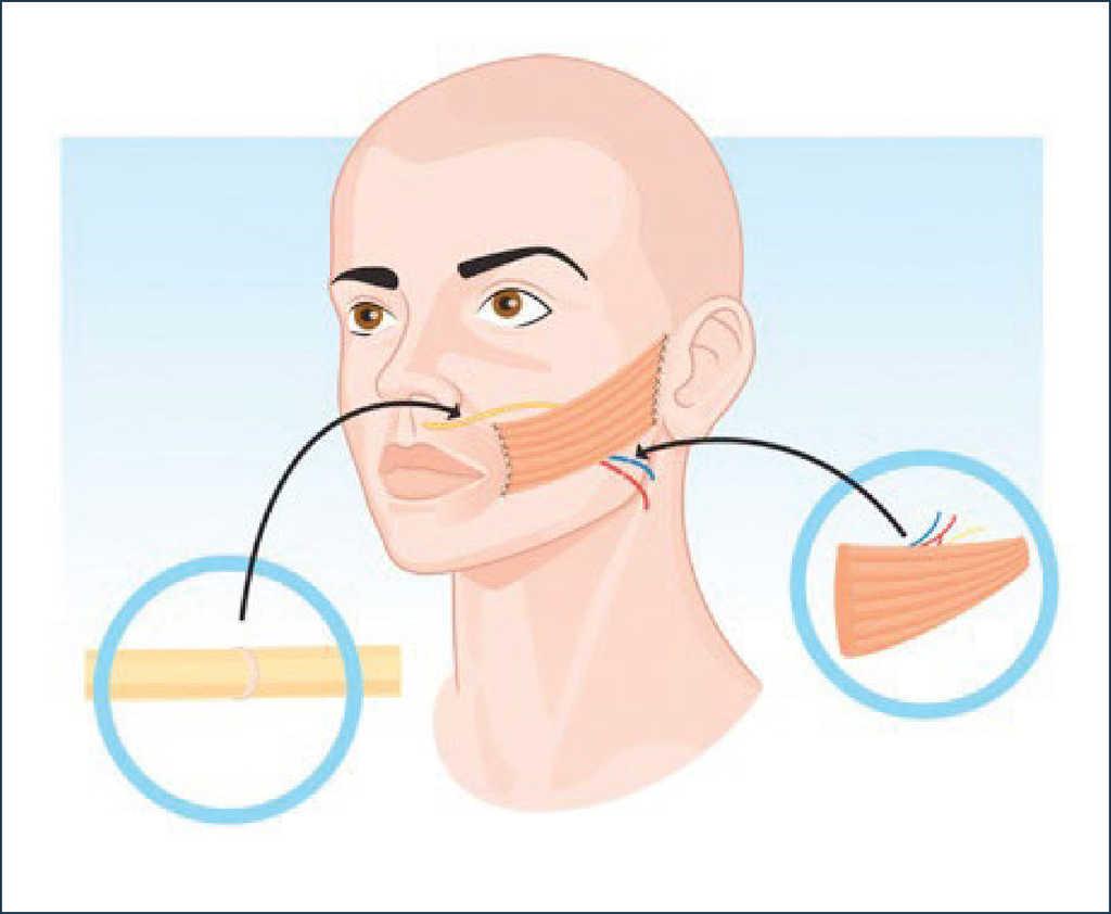Causas de paralisis facial central pdf online