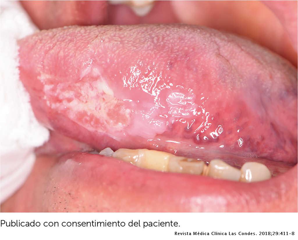 cancer bucal articulos cientificos hpv lesion on lip