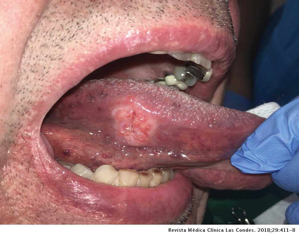 Cancer bucal tabaco - Cancer bucal lengua