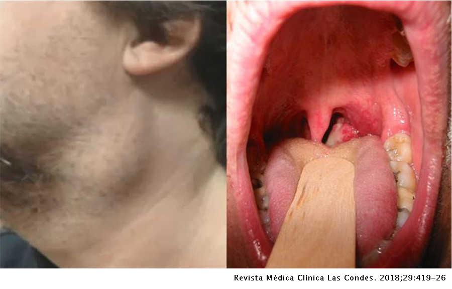 cancer de boca hpv sintomas