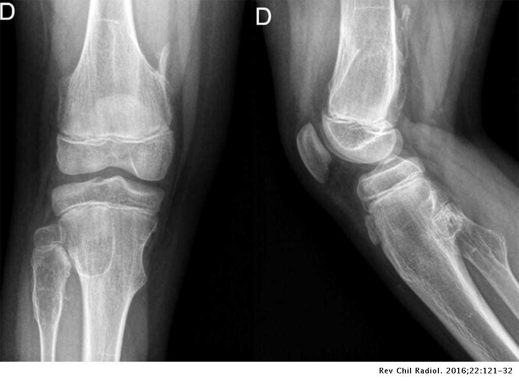 Pase para saber Esperar algo Compañero Lesiones y variantes normales de la rodilla pediátrica | Revista Chilena de  Radiología