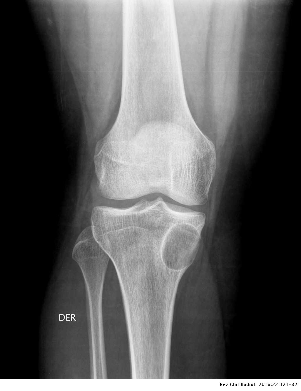 Pase para saber Esperar algo Compañero Lesiones y variantes normales de la rodilla pediátrica | Revista Chilena de  Radiología