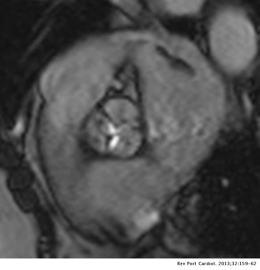 Cardiac magnetic resonance in a patient with MRI-conditional pacemaker ...