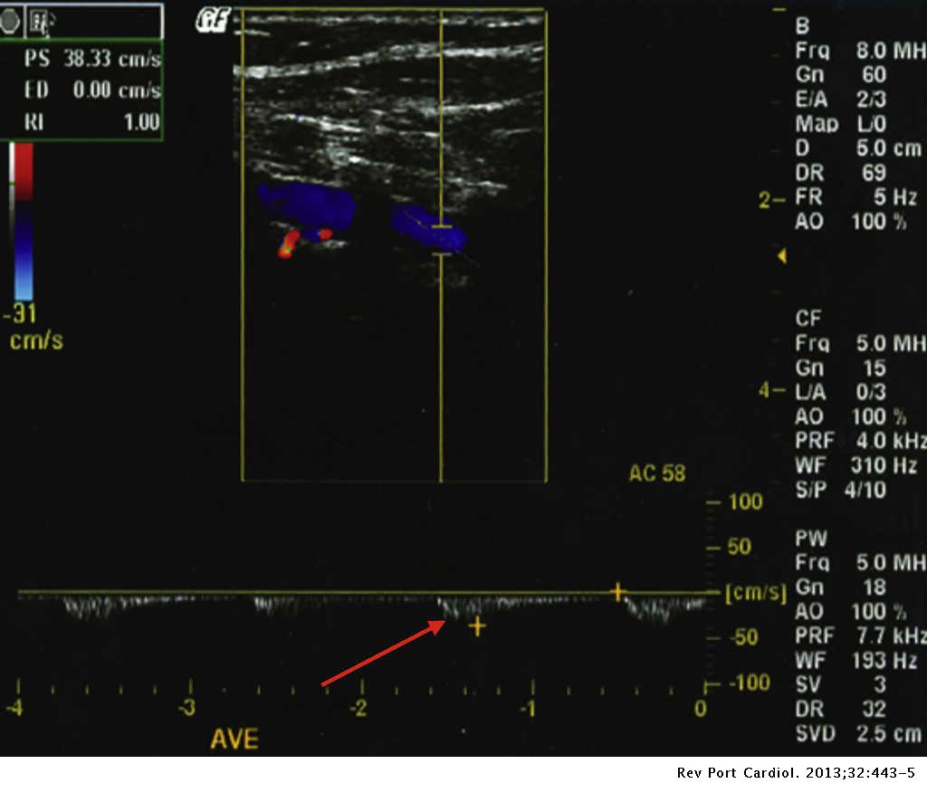 A Case Of Coronary Vertebral Subclavian Steal Syndrome Revista Portuguesa De Cardiologia English Edition