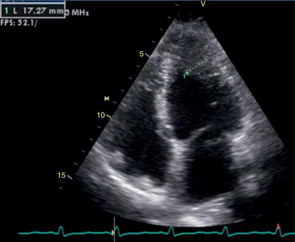 Fabry disease presenting as apical left ventricular hypertrophy in a patient carrying the ...