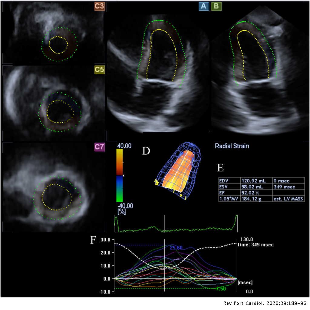 Active Acromegaly Is Associated With Enhanced Left Ventricular Contractility Results From The Three Dimensional Speckle Tracking Echocardiographic Magyar Path Study Revista Portuguesa De Cardiologia