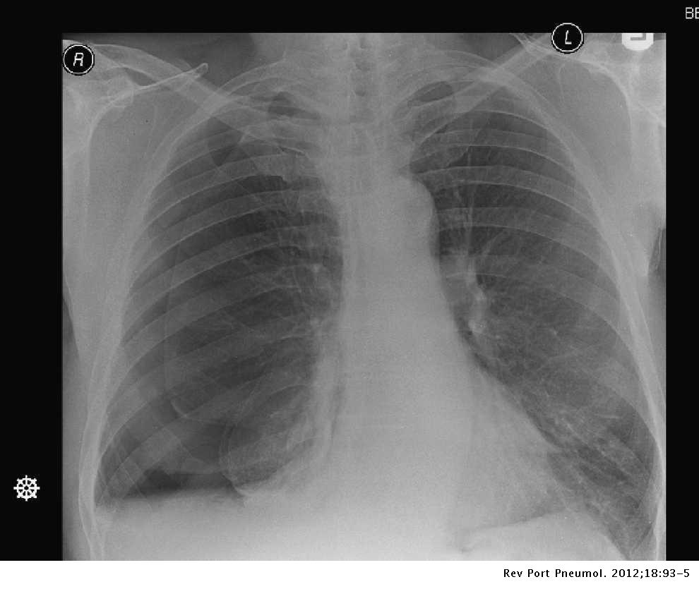 o que causa derrame pulmonar