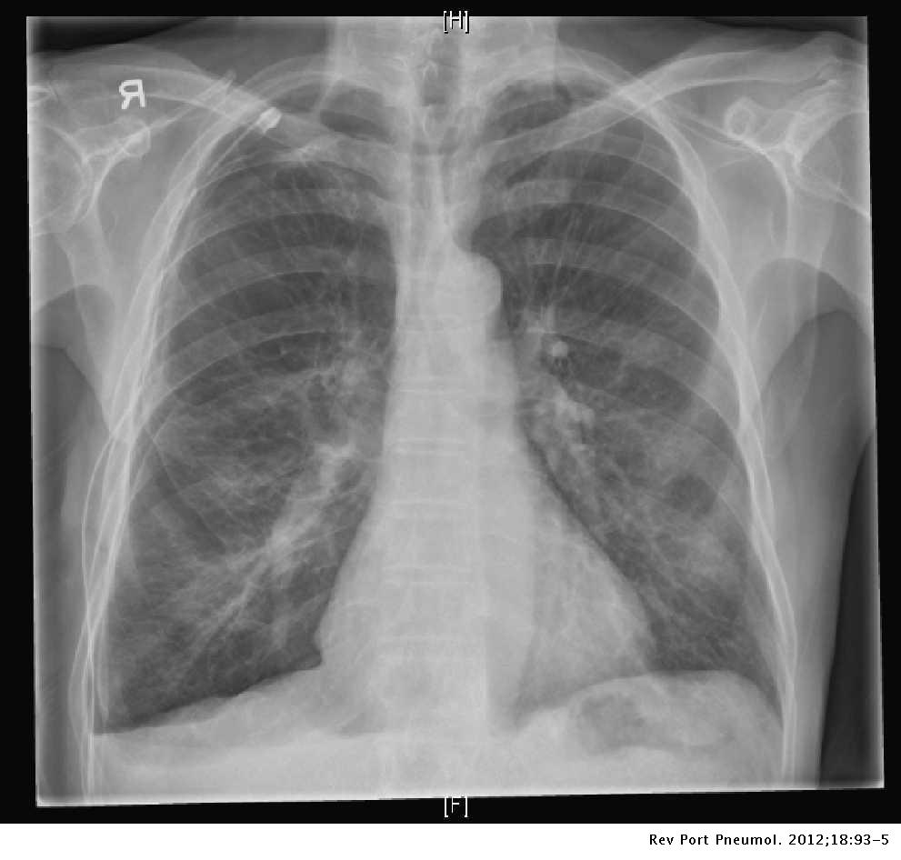 how is panlobular emphysema diagnosed