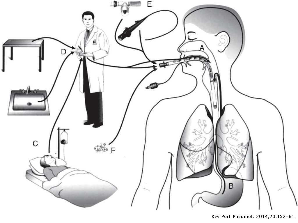 Pneumonia ventilator associated Ventilator