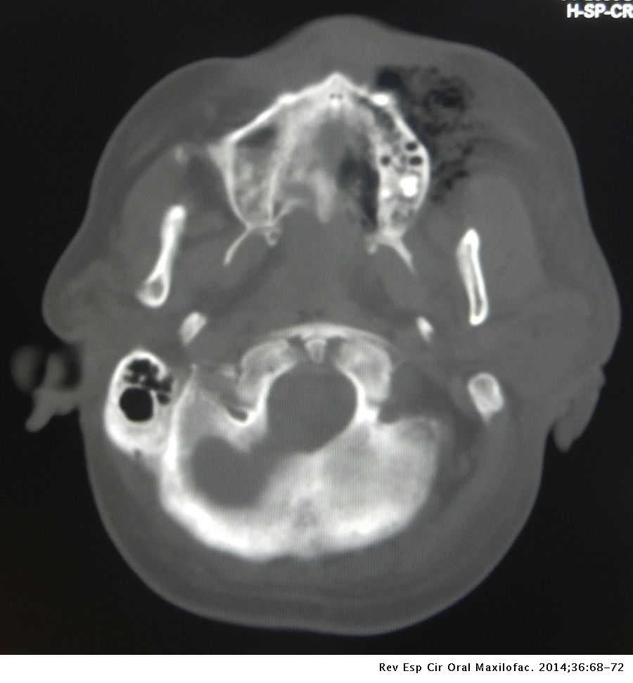 Mucormicosis rinocerebral de origen dental, reporte de un caso clínico