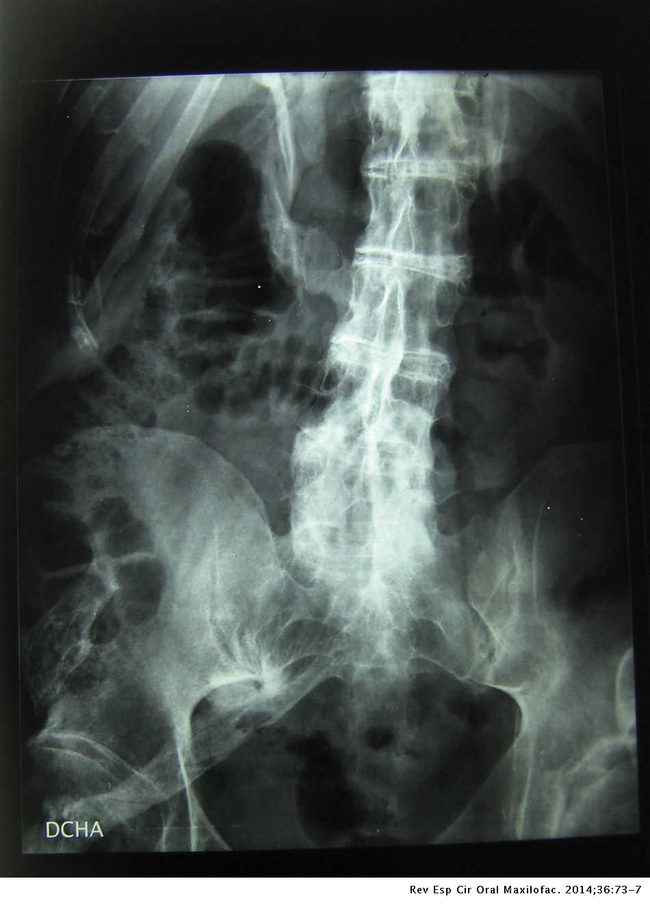 Krónikus prosztatagyulladás a fibrózis stádiumában Fibrózis és prosztata sclerosis