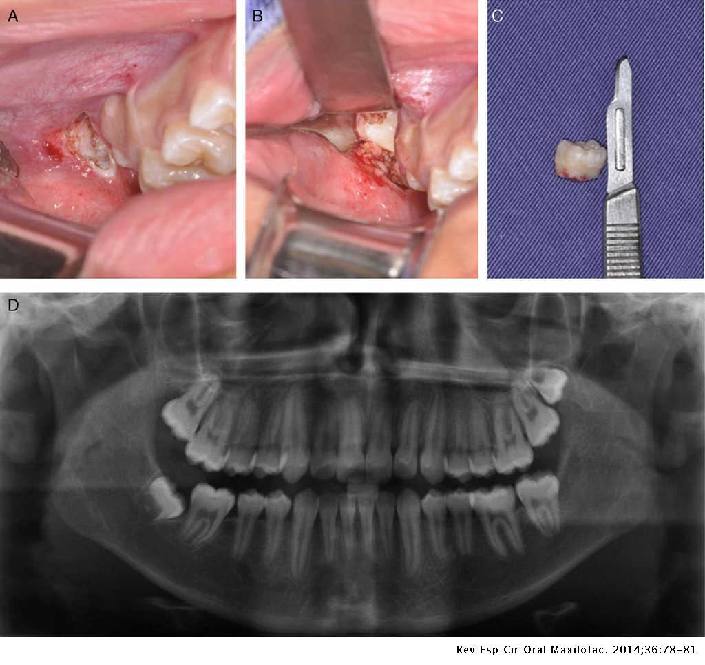 Delayed Removal Of Maxillary Third Molar Displaced Into The