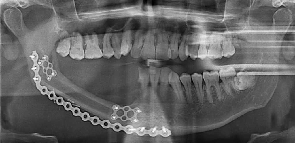 Microvascular reconstruction of the mandible: An argument for the