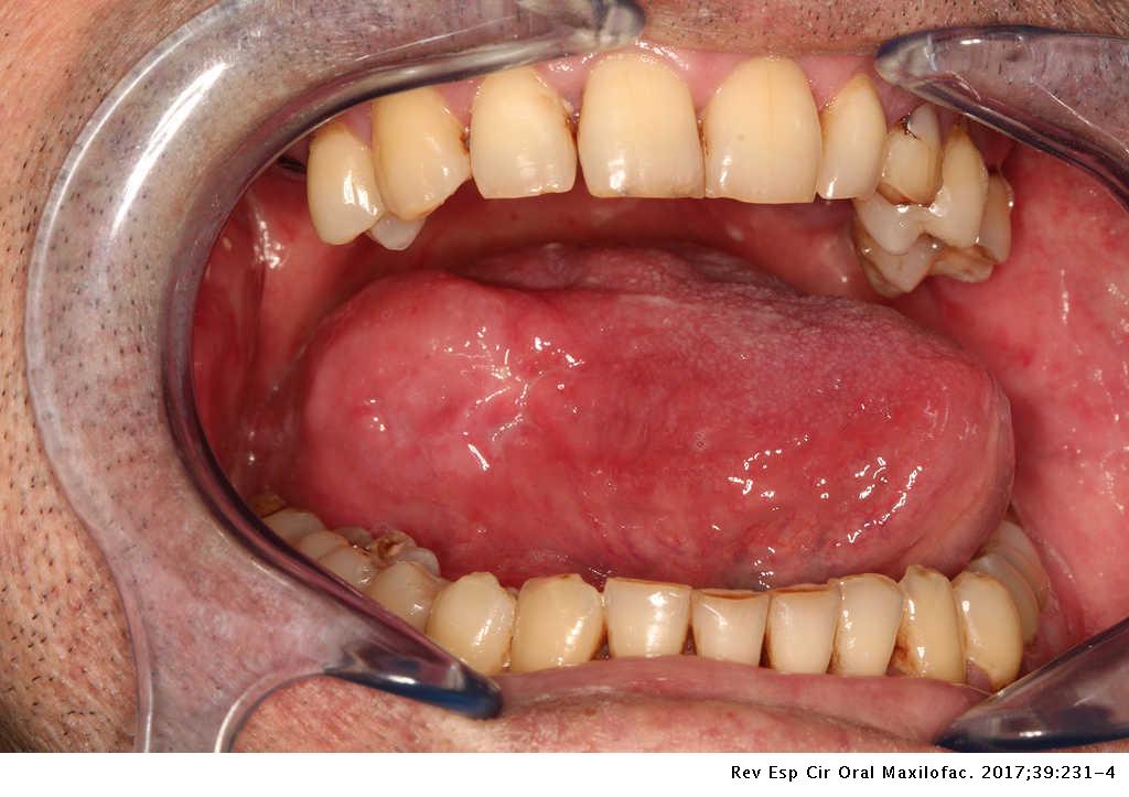 Leiomyosarcoma Of The Tongue A Rare Case Report Revista Espanola De Cirugia Oral Y Maxilofacial