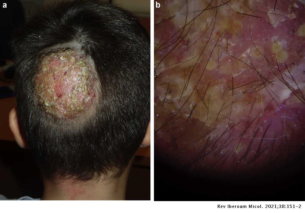 Kerion Celsi caused by Trichophyton tonsurans with dermatophytid reaction | Revista Iberoamericana de Micología Kerion Celsi caused by Trichophyton tonsurans with dermatophytid reaction | Revista Iberoamericana de Micología